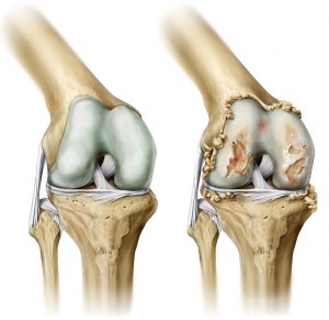 Izquierda: articulación de la rodilla sana. Derecha: articulación de la rodilla con artrosis (destrucción de hueso, ligamentos y cartílago)